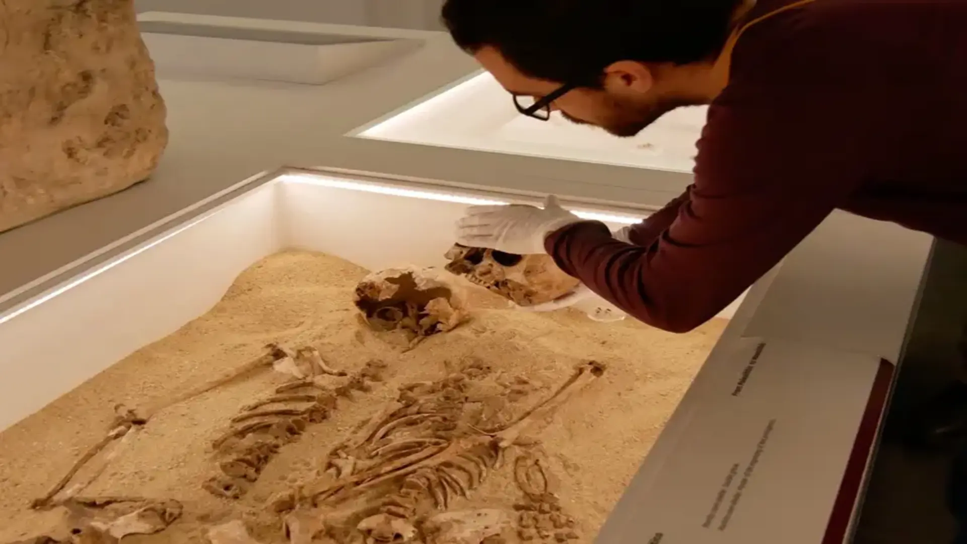 12,000-year-old case of super rare genetic disease confirmed in new study