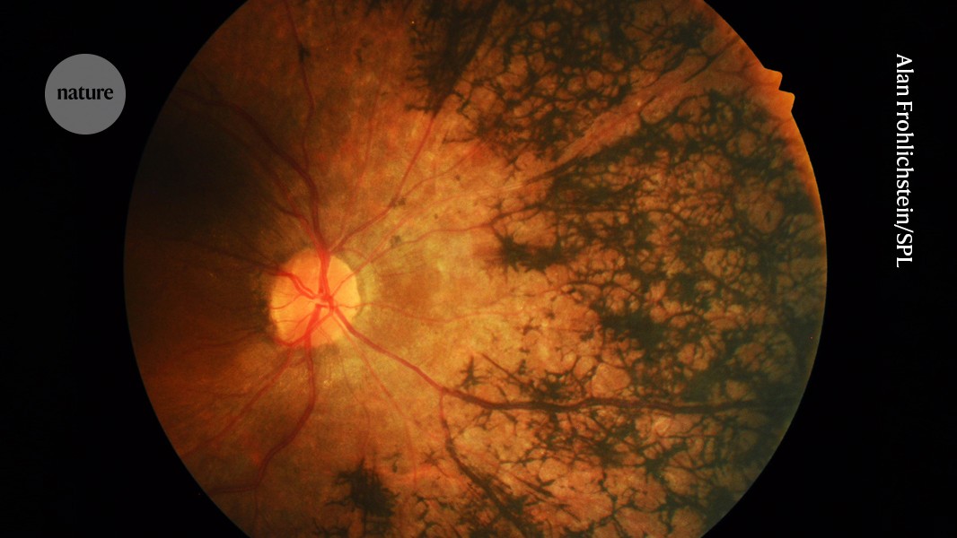 Cause of vision loss discovered in overlooked genes