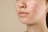 Why Do Humans Get Acne, and Is it Unique to Us? Here’s What to Know