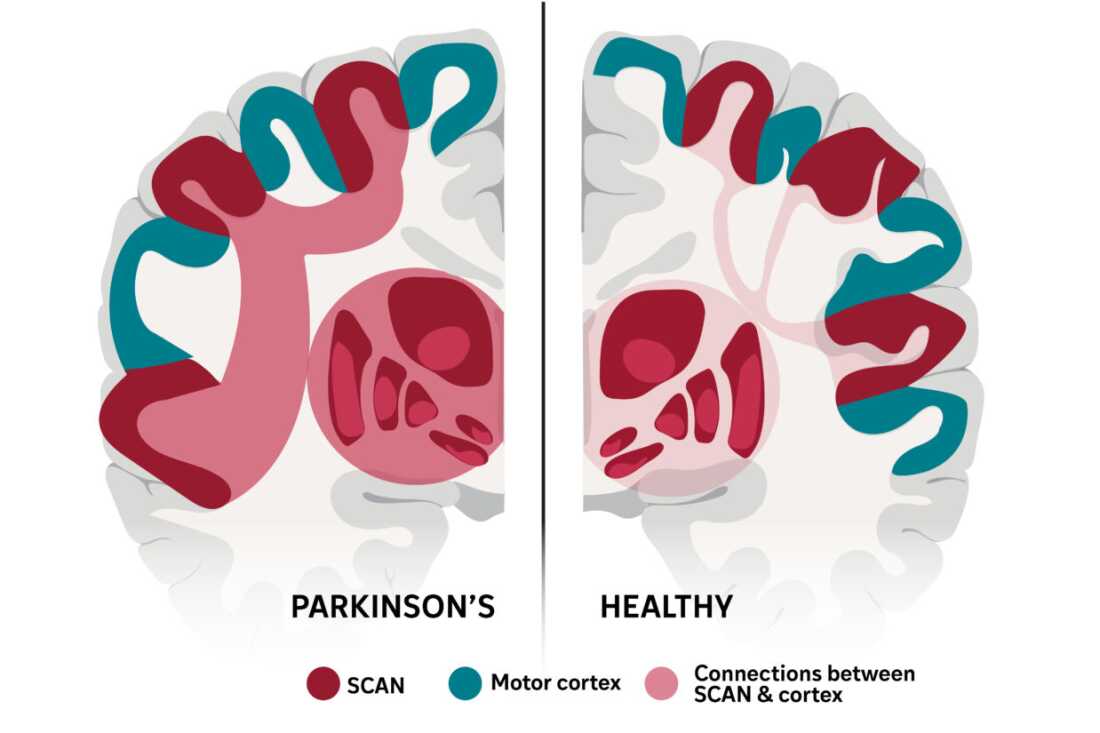 This complex brain network may explain many of Parkinson’s stranger symptoms : NPR