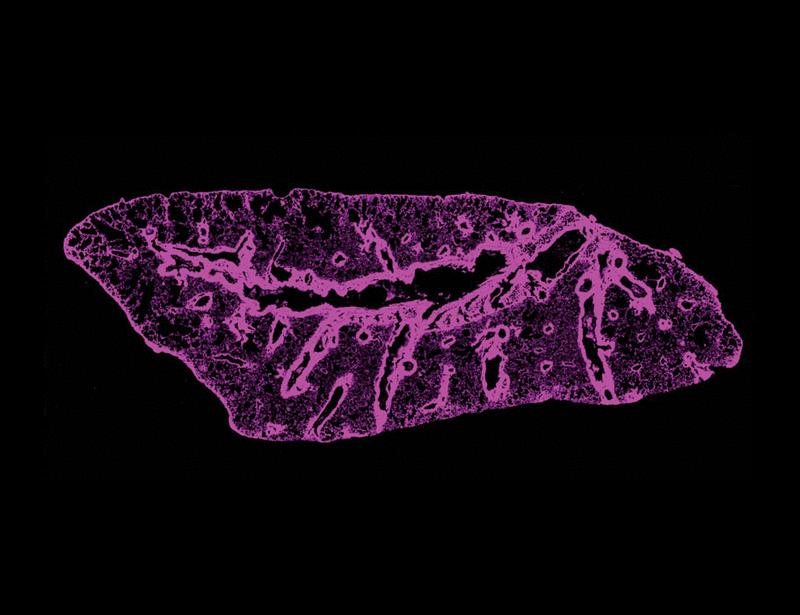 Lymphatic disruption drives lung transplant fibrosis through interleukin-1–mediated hyaluronan accumulation | Science Translational Medicine