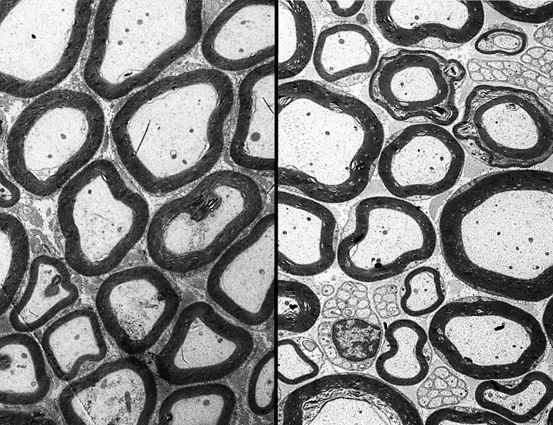 BDNF Val66Met protects oxaliplatin-induced peripheral neuropathy in patients with colorectal cancer | Science Translational Medicine