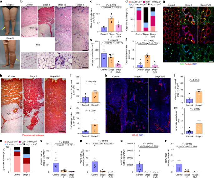 Targeting excessive cholesterol deposition alleviates secondary lymphoedema