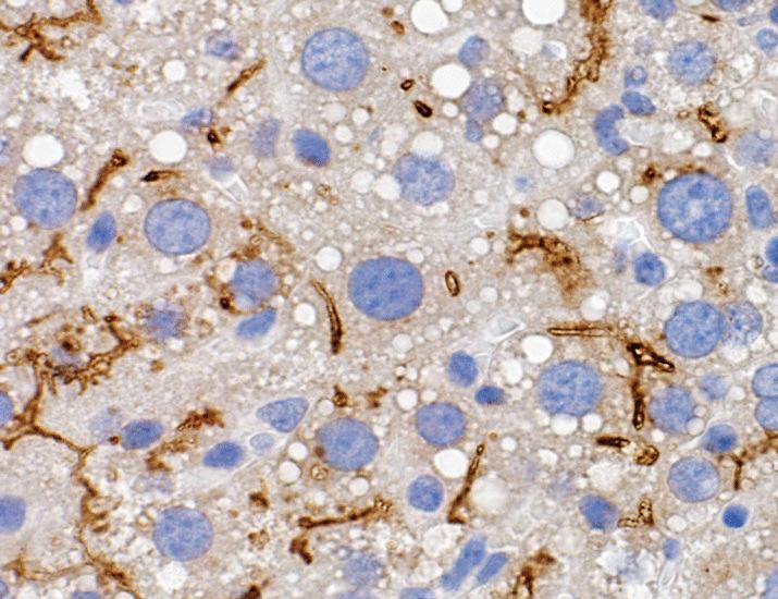 AAV8 gene therapy and dietary insults together precipitate cholestatic liver disease in a mouse model of X-linked myotubular myopathy | Science Translational Medicine