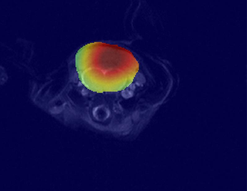 Lactylation fuels nucleotide biosynthesis and facilitates deuterium metabolic imaging of tumor proliferation in preclinical models of H3K27M-mutant gliomas | Science Translational Medicine