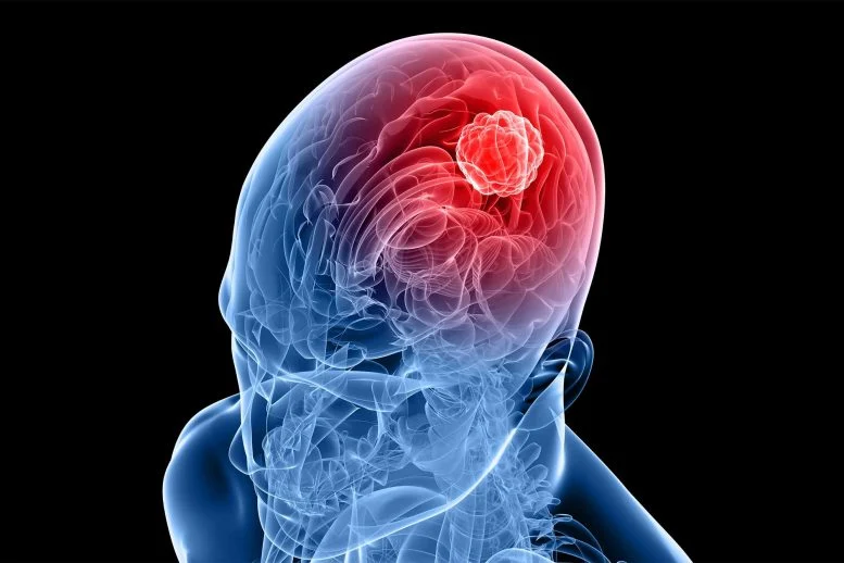 New Molecule Blocks Deadliest Brain Cancer at Its Genetic Root