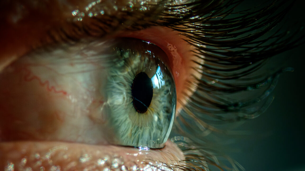 Bad sleep made woman’s eyelids so floppy they flipped inside out, got stuck