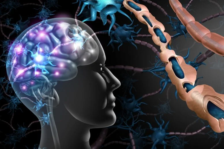 MS Could Begin More Than a Decade Before Symptoms – New Research Rewrites the Timeline