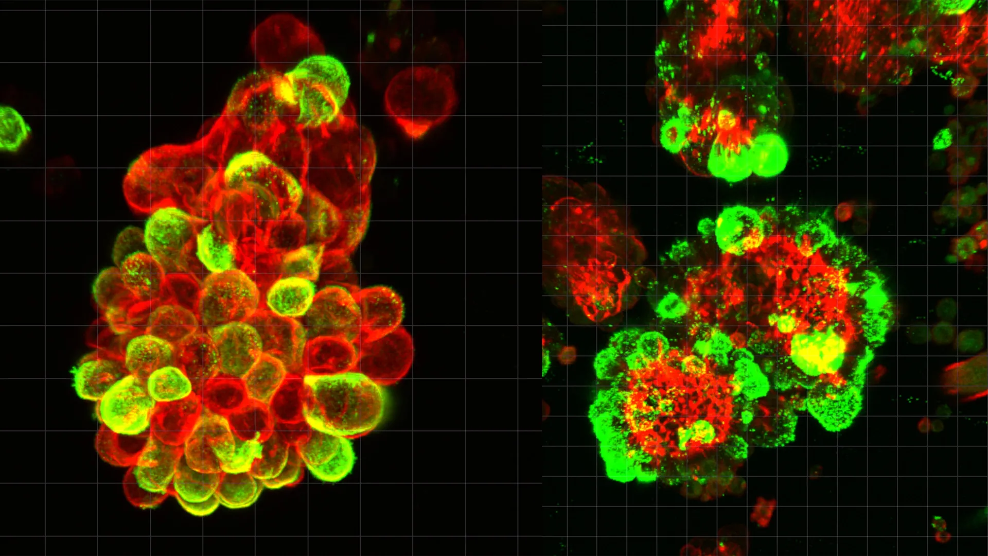 A secret cell alliance may explain why ovarian cancer is so deadly