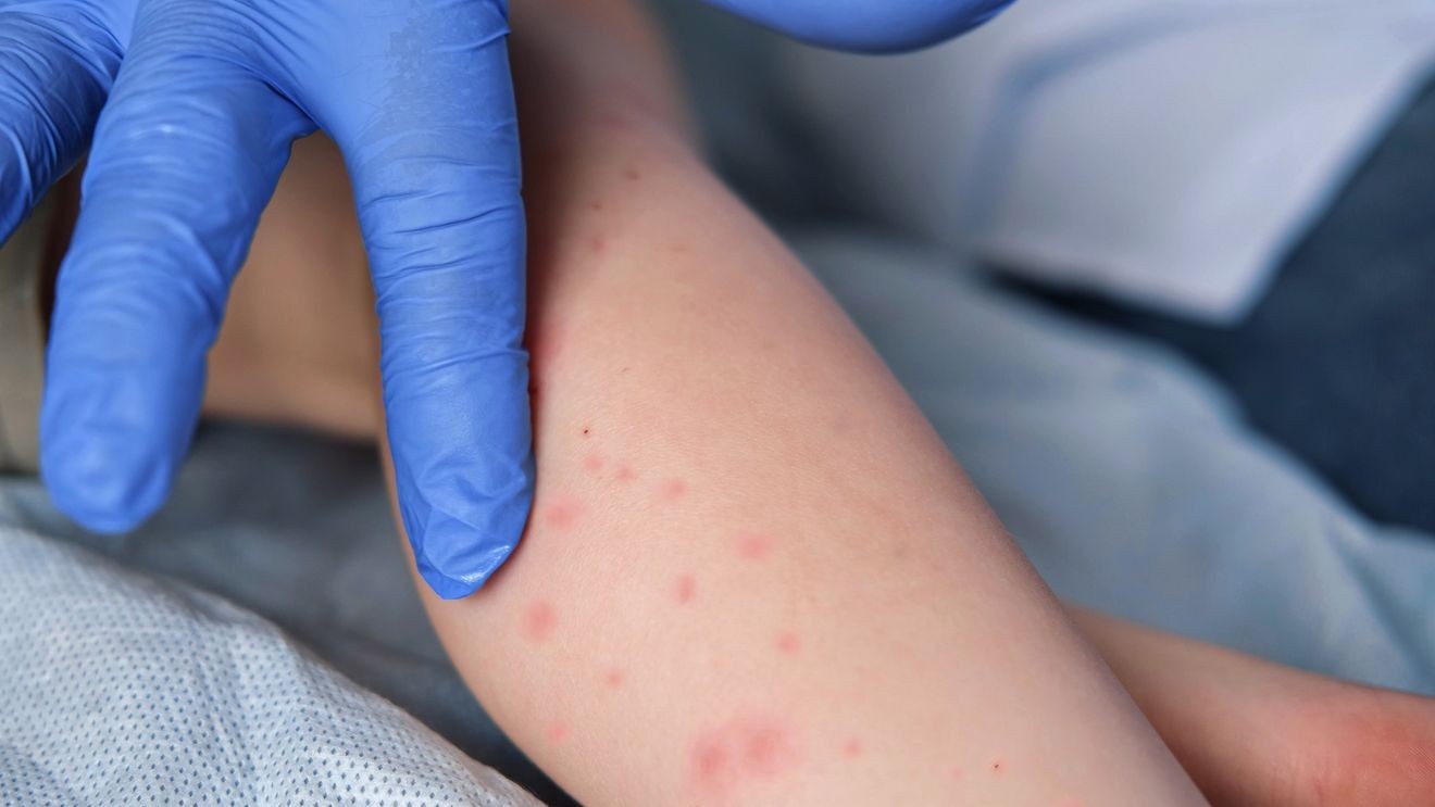 Measles case confirmed in Pensacola area