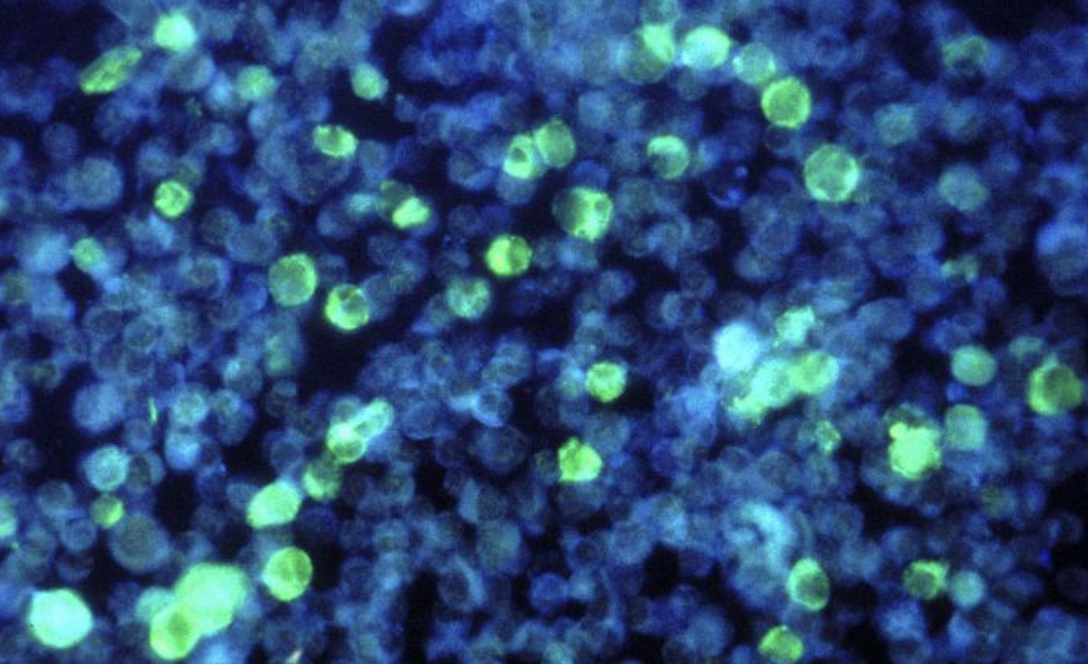 How Epstein-Barr Virus & Genetic Factors Can Lead to Multiple Sclerosis