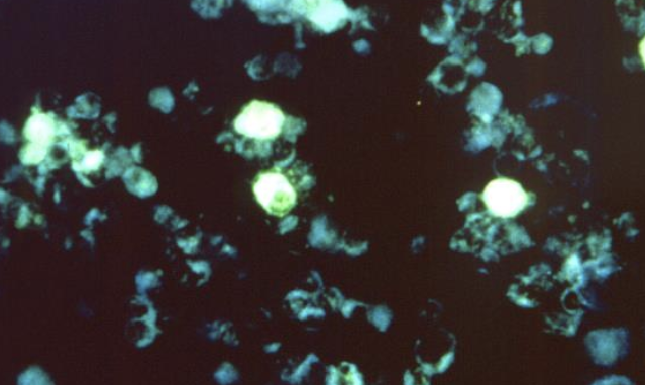 Gene Variants Influence Long-Term Illness Risk After Viral Infection