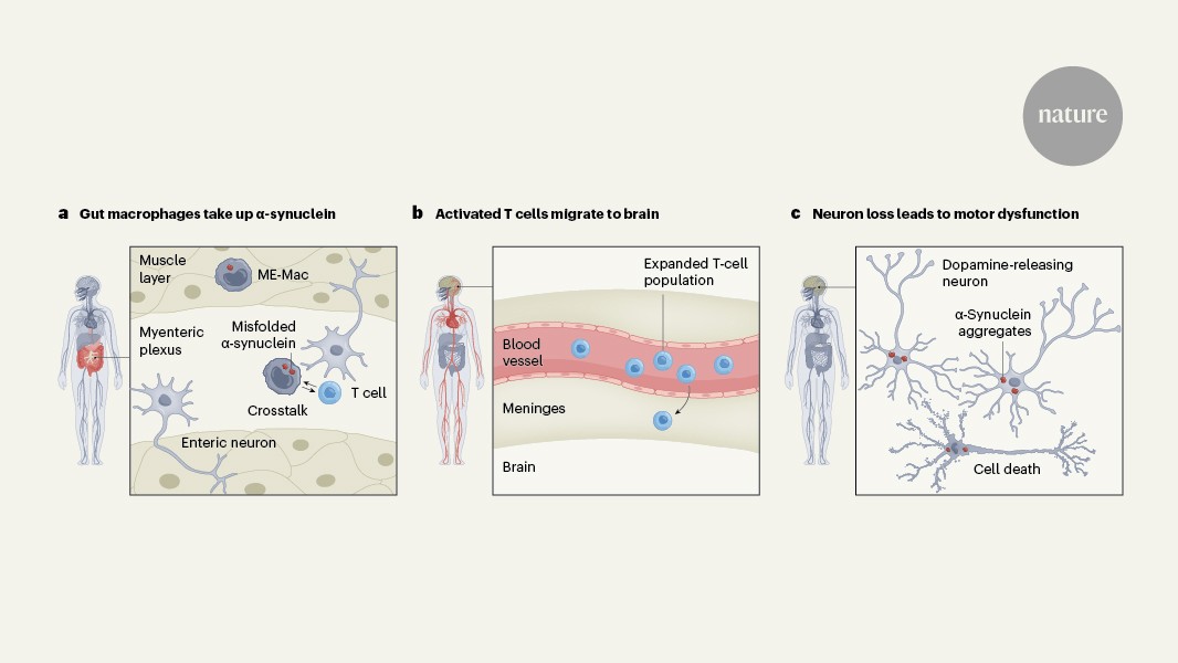 Immune cells from the gut drive development of Parkinson’s disease in the brain