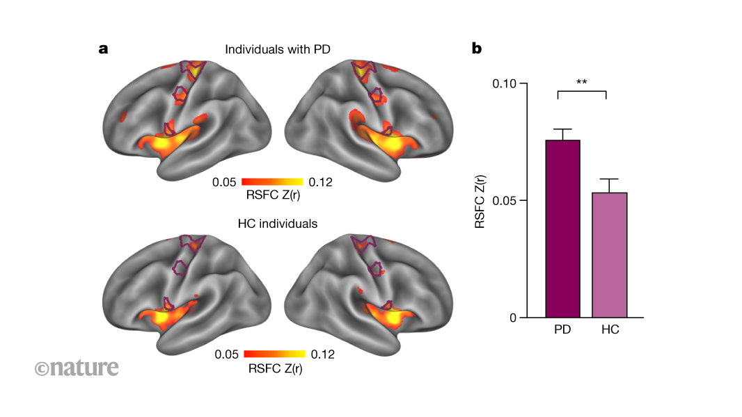 Parkinson’s disease affects network of brain regions that controls whole-body action