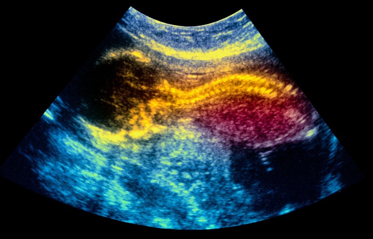 World-first stem-cell therapy shows promise for treating spina bifida in the womb