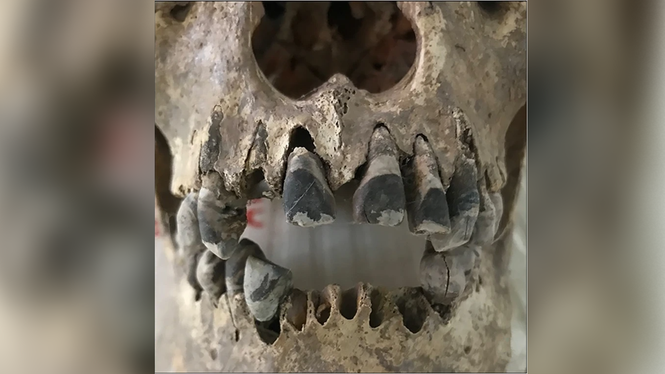 2,000-year-old skulls reveal people in ancient Vietnam permanently blackened their teeth — a stylish practice that persists today