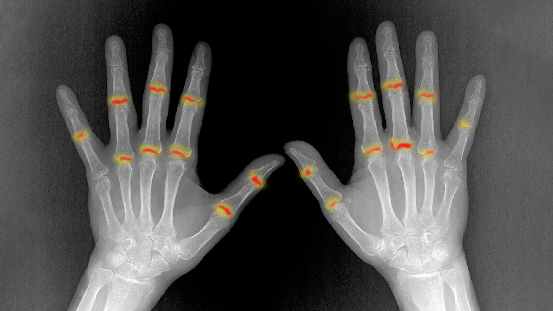 Scientists uncover why psoriasis can turn into joint disease