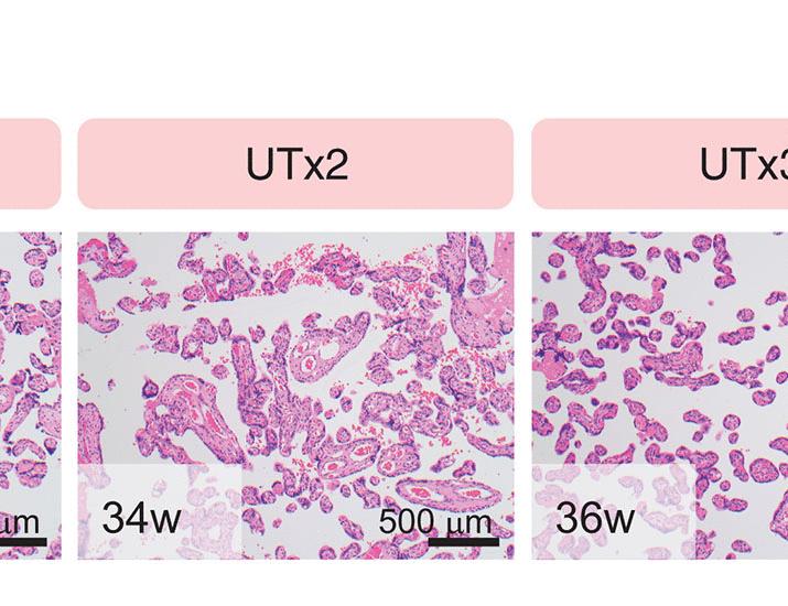 Inhibition of NFAT after human uterus transplant promotes loss of tissue-resident NK cells and attendant pregnancy complications | Science Translational Medicine