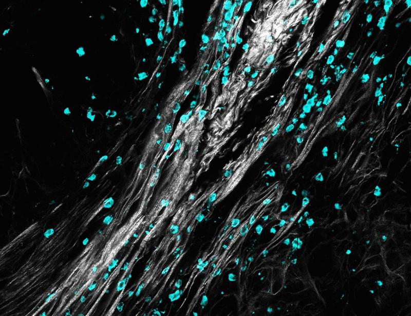 Macrophages restrict tumor immune infiltration by controlling collagen topography | Science Immunology
