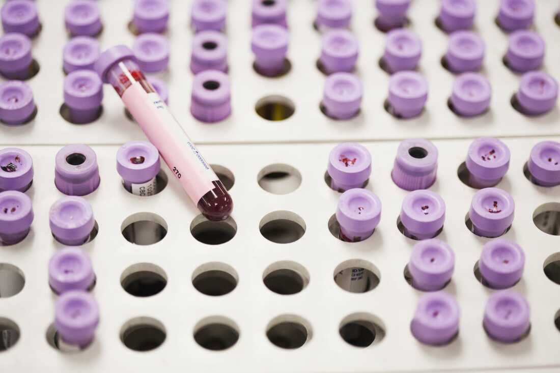 New guidelines offer new approach for managing high cholesterol : NPR