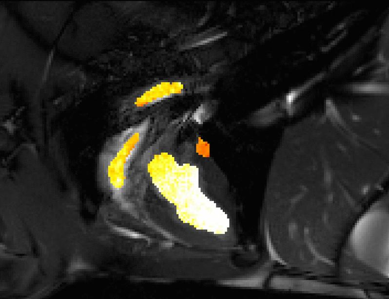 Quantifying myocardial oxygen consumption and efficiency with motion-resolved cardiac MRI | Science Translational Medicine