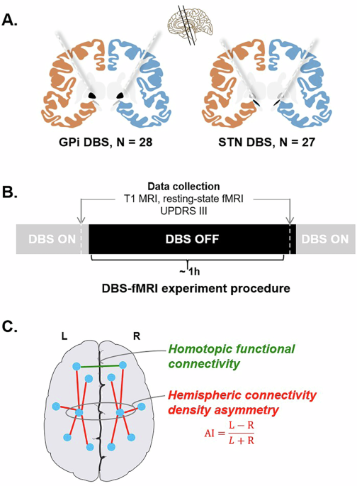 Pallidal and subthalamic stimulations modulate inter-hemispheric interaction and asymmetry in Parkinson’s disease