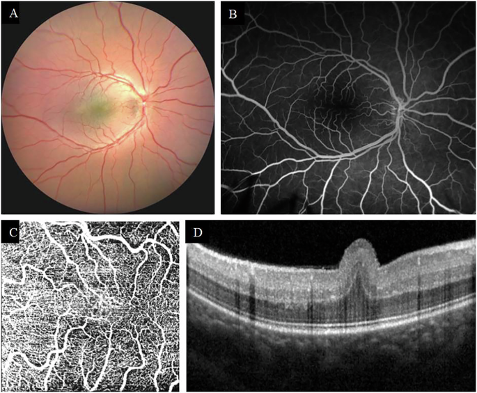 Multimodal imaging in nanophthalmos