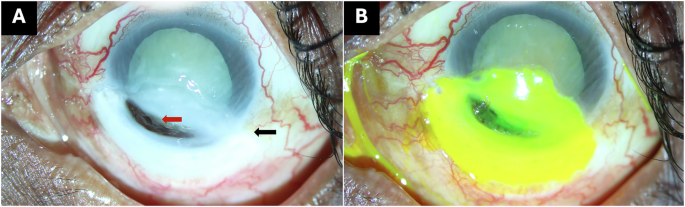 Corneo-scleral necrosis following diode laser cyclophotocoagulation