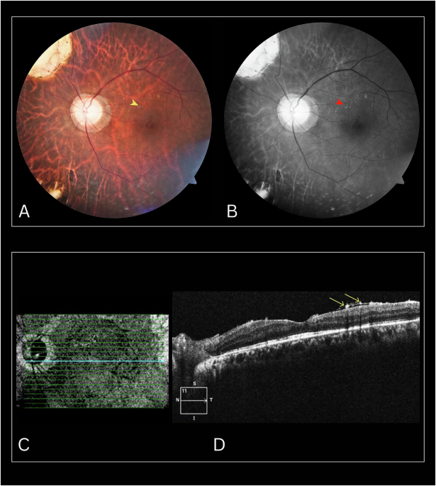 Sub-ERM silicone oil deposits: OCT insights into a rare entity