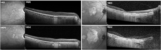 Clinical characteristics and progression rates of geographic atrophy in an Asian population from Singapore