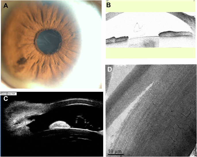 True exfoliation syndrome