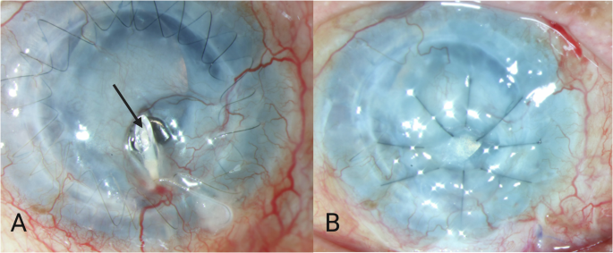 Ahmed shunt extrusion through prior penetrating keratoplasty graft