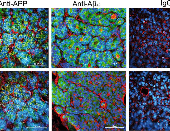 Amyloid-β as a target to suppress tonic PTH hypersecretion in hyperparathyroidism due to vitamin D deficiency | Science Translational Medicine