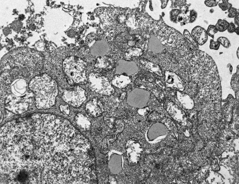 Acarbose ameliorates podocyte injury and glomerular lesions in diabetic nephropathy through USP46 activation | Science Translational Medicine