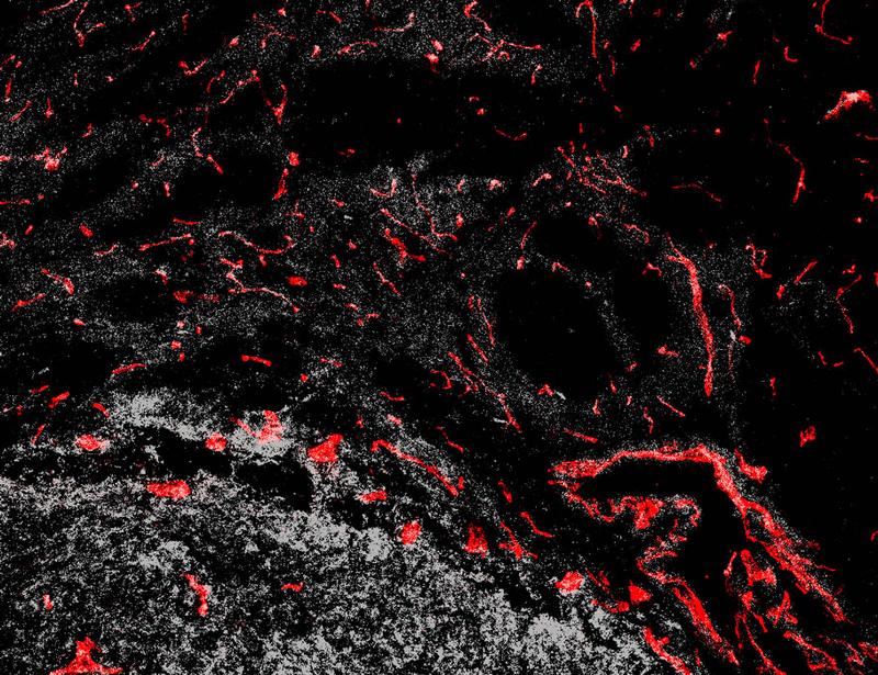 Engineering CAR T cells to secrete VEGF-neutralizing scFvs enhances antitumor activity against solid tumors | Science Translational Medicine