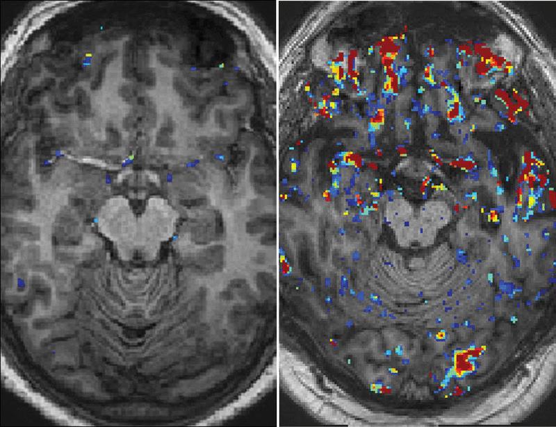 Blood-brain barrier disruption, traumatic encephalopathy, and cognitive decline in retired athletes | Science Translational Medicine