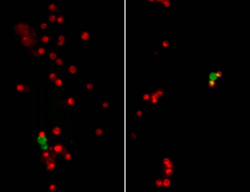 Dual-positive CTCs in patients with advanced breast cancer show metastatic potential and prognostic value | Science Translational Medicine