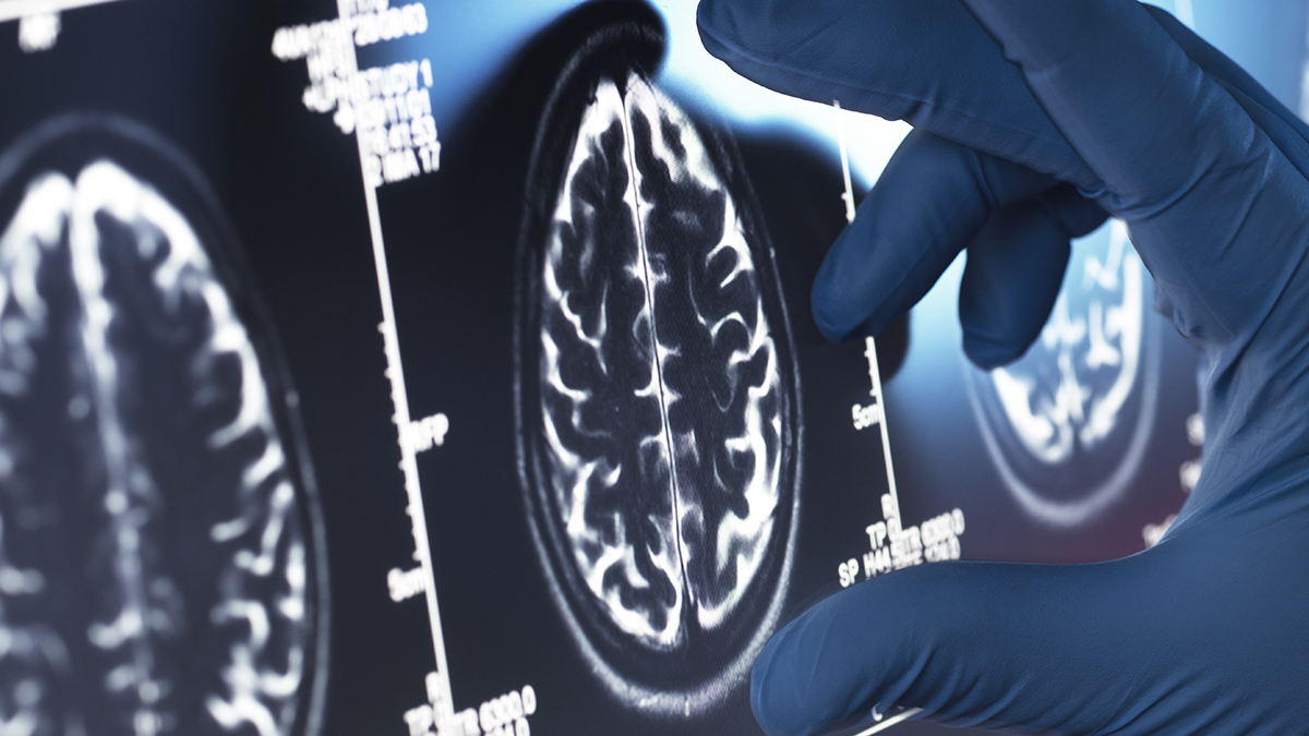 Viagara May Be One of Our Best Existing Options For an Alzheimer’s Treatment : ScienceAlert