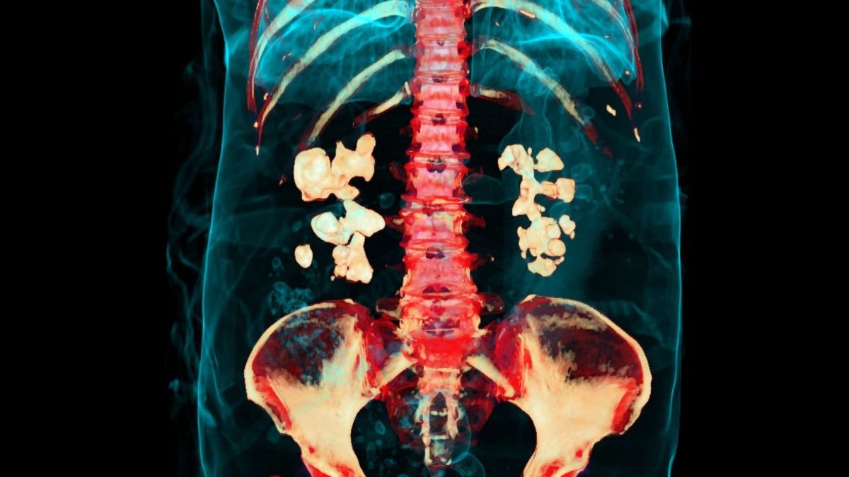 Bacteria Play Previously Unknown Role in Kidney Stones, Study Finds : ScienceAlert