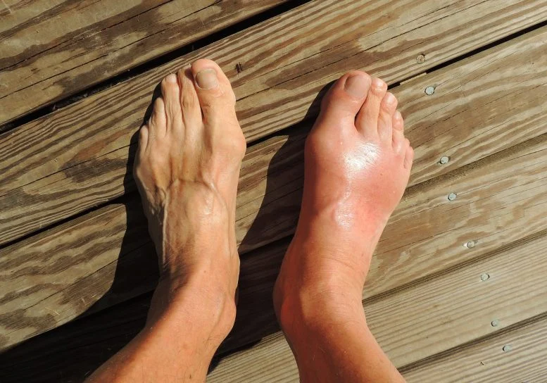 Scientists Discover a Better Way To Treat Gout for Certain Patients