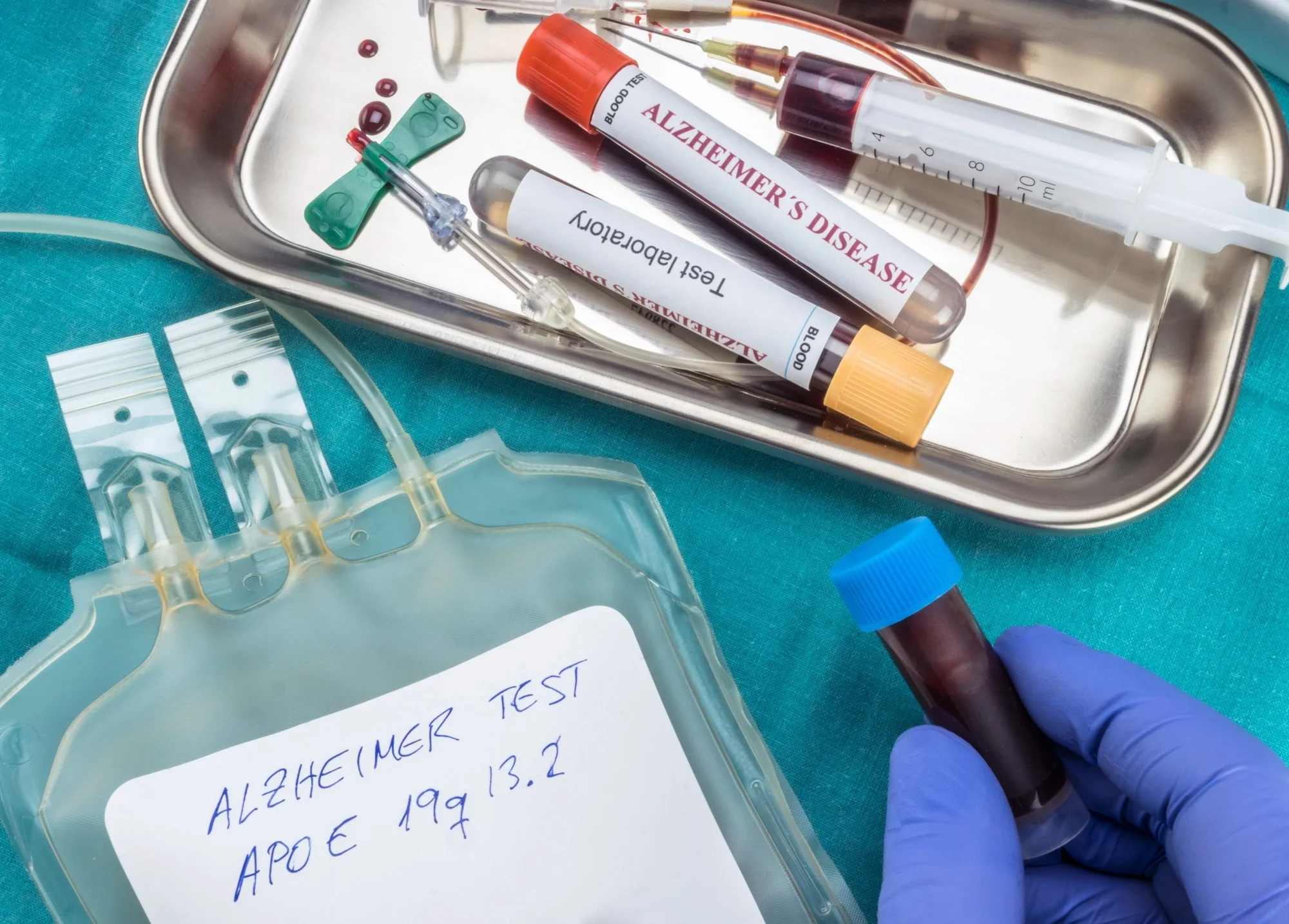 Early alzheimer’s detection through blood protein analysis