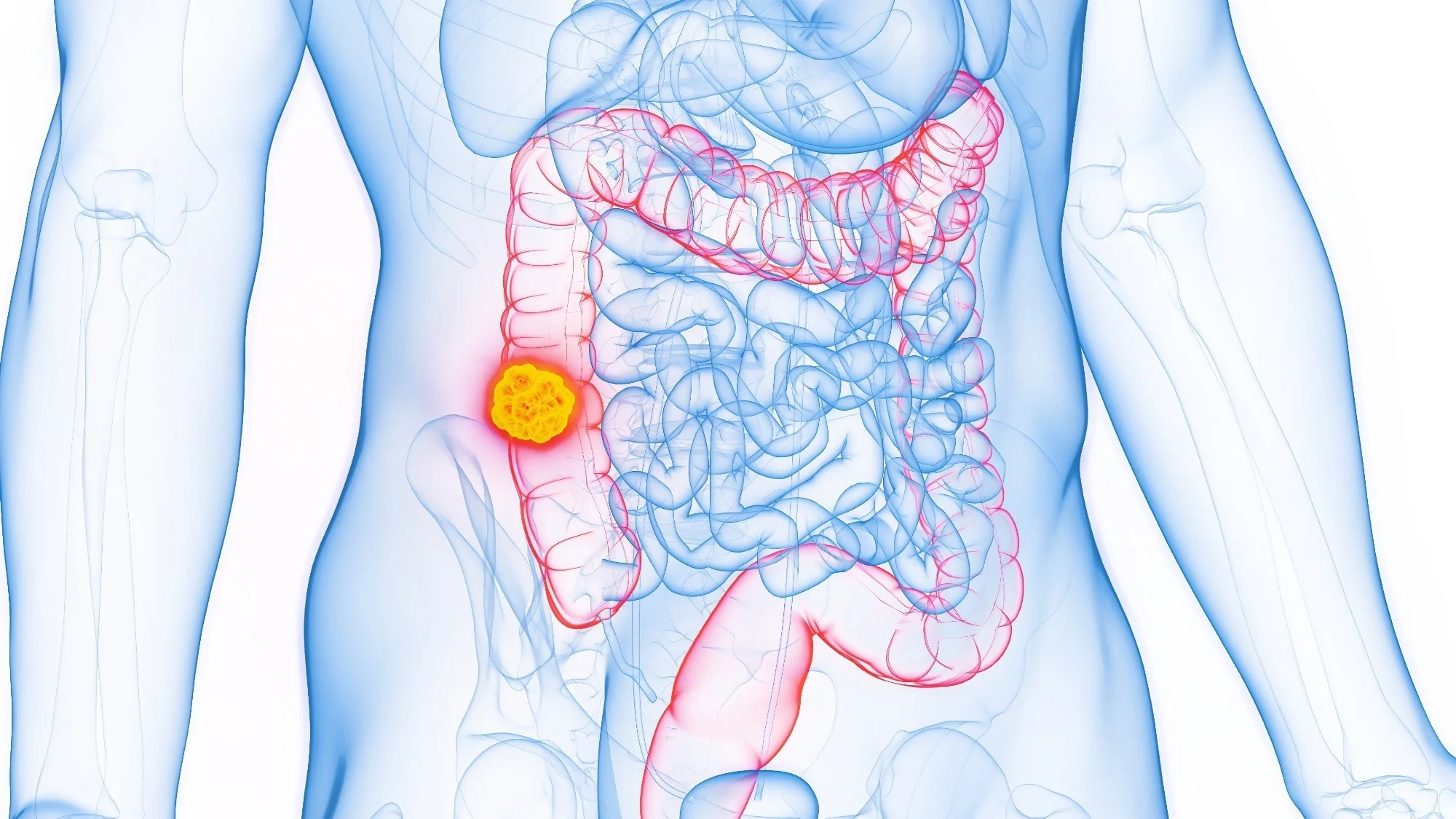 Tumor debulking fails to improve survival in colorectal cancer
