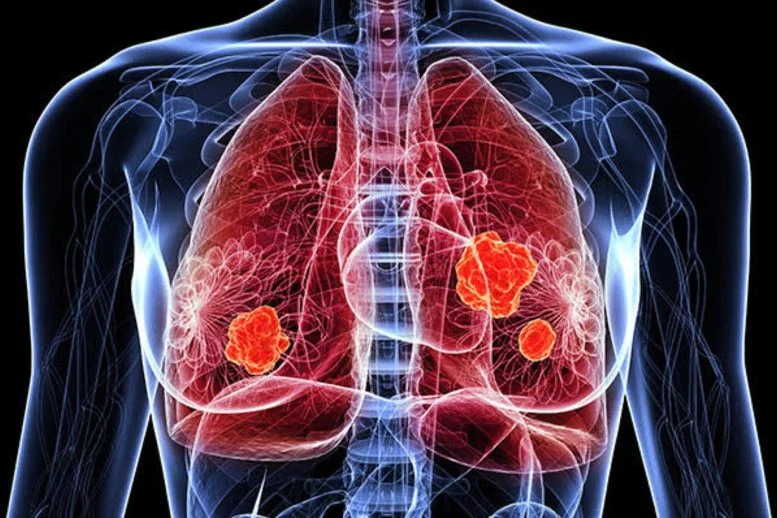 A Bad Case of COVID or Flu May Raise Lung Cancer Risk Years Later