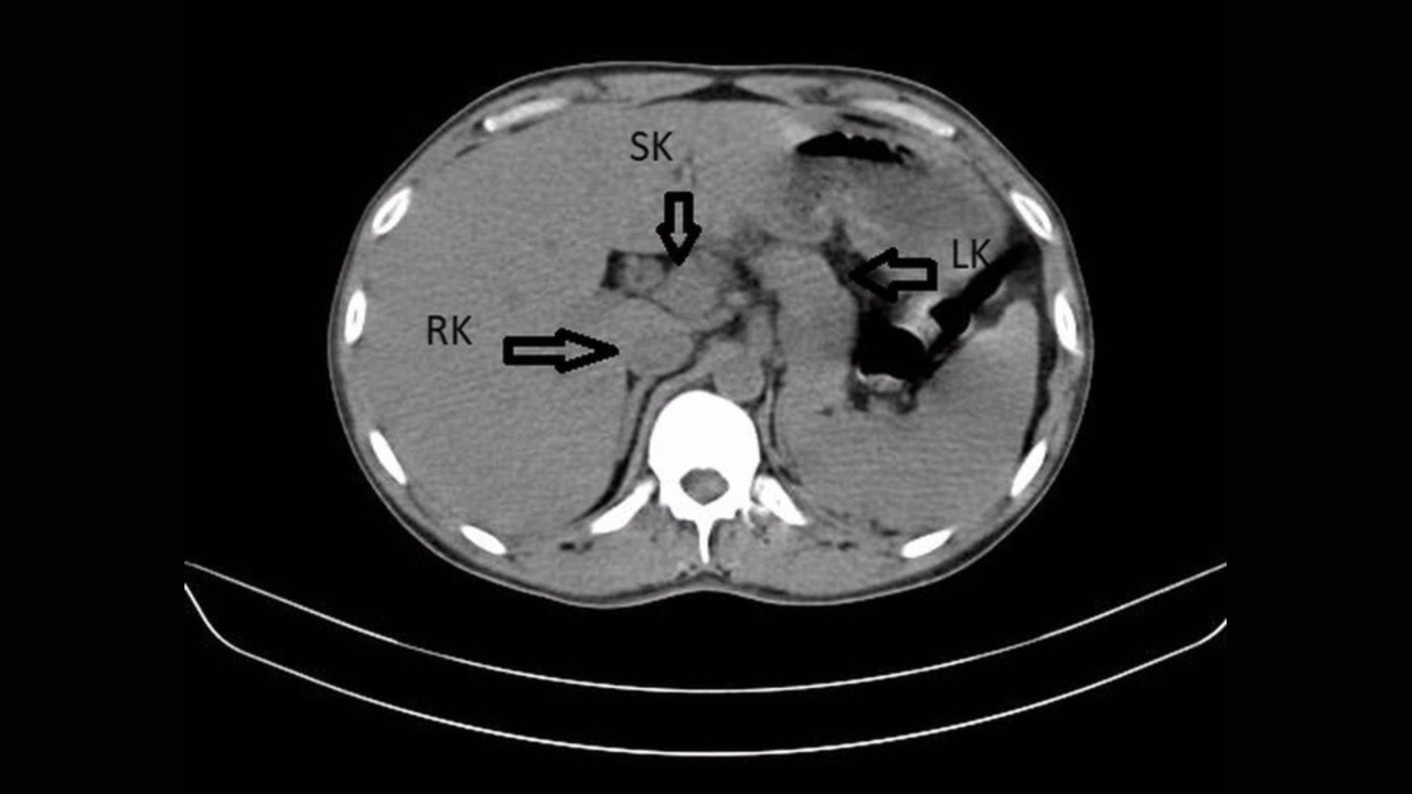 Diagnostic dilemma: A man’s back pain led to the discovery of a third kidney