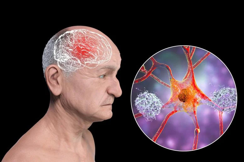 FDA-Approved Seizure Drug May Stop Alzheimer’s Before It Starts