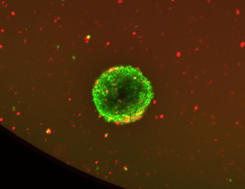 Drug screening on tumor organoids exposes therapeutic vulnerabilities of meningiomas to HDAC1/2i panobinostat | Science Translational Medicine