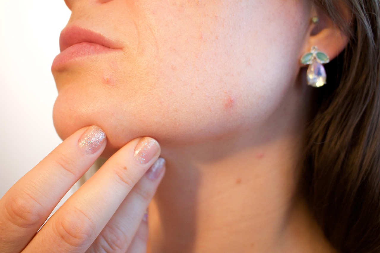 Retinoids, Benzoyl Peroxide, and Antibiotics Explained