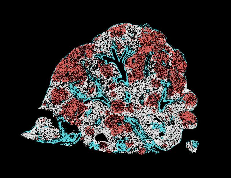 Modulating AP-1 enables CAR T cells to establish an intratumoral stemlike reservoir and overcomes resistance to PD-1 blockade | Science Immunology