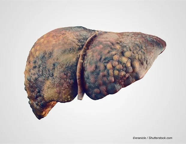 New fragmentome technology can detect early liver fibrosis and cirrhosis
