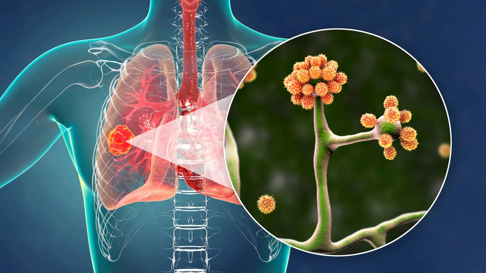 This simple blood protein could stop a deadly black fungus